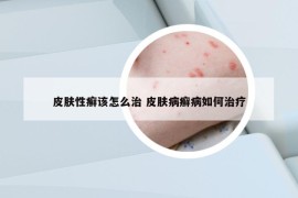 皮膚性癬該怎么治 皮膚病癬病如何治療