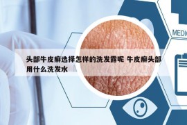 頭部牛皮癬選擇怎樣的洗發(fā)露呢 牛皮癬頭部用什么洗發(fā)水