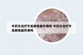 中藥方治療牛皮癬有副作用嗎 中藥方治療牛皮癬有副作用嗎
