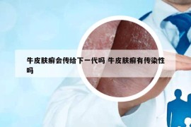 牛皮膚癬會(huì)傳給下一代嗎 牛皮膚癬有傳染性嗎