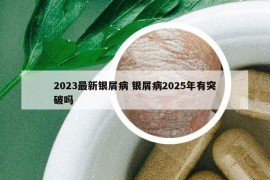 2023最新銀屑病 銀屑病2025年有突破嗎