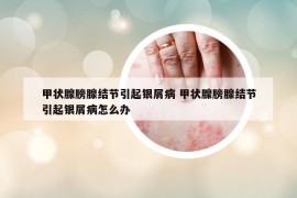 甲狀腺膀腺結節(jié)引起銀屑病 甲狀腺膀腺結節(jié)引起銀屑病怎么辦