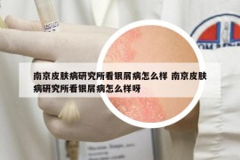 南京皮膚病研究所看銀屑病怎么樣 南京皮膚病研究所看銀屑病怎么樣呀