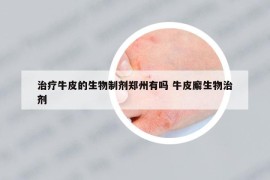 治療牛皮的生物制劑鄭州有嗎 牛皮廨生物治劑
