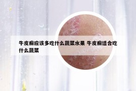 牛皮癬應(yīng)該多吃什么蔬菜水果 牛皮癬適合吃什么蔬菜