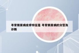 尋常銀屑病皮疹特征是 尋常銀屑病的分型及診斷