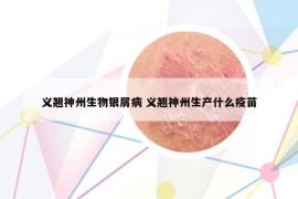 義翹神州生物銀屑病 義翹神州生產(chǎn)什么疫苗