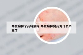 牛皮癬抹了藥特別癢 牛皮癬抹完藥為什么嚴(yán)重了