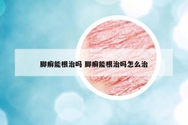 腳癬能根治嗎 腳癬能根治嗎怎么治