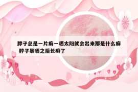 脖子總是一片癬一曬太陽(yáng)就會(huì)出來(lái)那是什么癬 脖子暴曬之后長(zhǎng)癬了