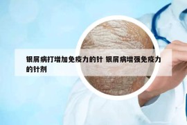 銀屑病打增加免疫力的針 銀屑病增強(qiáng)免疫力的針劑