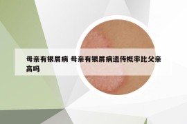 母親有銀屑病 母親有銀屑病遺傳概率比父親高嗎