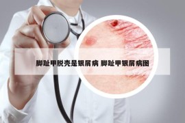 腳趾甲脫殼是銀屑病 腳趾甲銀屑病圖