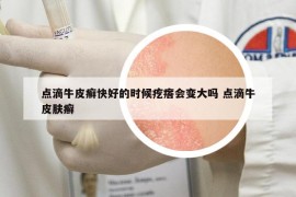 點(diǎn)滴牛皮癬快好的時(shí)候疙瘩會(huì)變大嗎 點(diǎn)滴牛皮膚癬