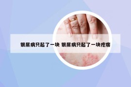銀屑病只起了一塊 銀屑病只起了一塊疙瘩