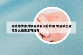哪些維生素對銀屑病有治療作用 銀屑病患者吃什么維生素有好處