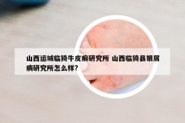 山西運城臨猗牛皮癬研究所 山西臨猗縣銀屑病研究所怎么樣?