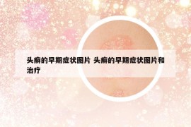 頭癬的早期癥狀圖片 頭癬的早期癥狀圖片和治療