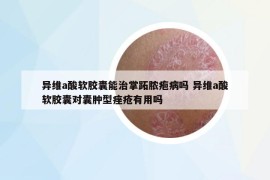 異維a酸軟膠囊能治掌跖膿皰病嗎 異維a酸軟膠囊對(duì)囊腫型痤瘡有用嗎