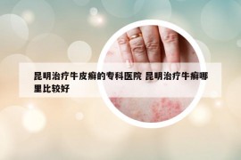 昆明治療牛皮癬的?？漆t(yī)院 昆明治療牛癬哪里比較好