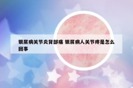 銀屑病關(guān)節(jié)炎背部痛 銀屑病人關(guān)節(jié)疼是怎么回事