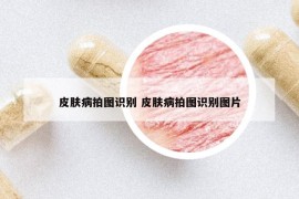 皮膚病拍圖識(shí)別 皮膚病拍圖識(shí)別圖片