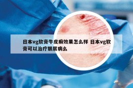 日本vg軟膏牛皮癬效果怎么樣 日本vg軟膏可以治療銀屑病么