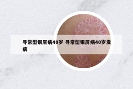 尋常型銀屑病40歲 尋常型銀屑病40歲發(fā)病