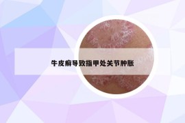 牛皮癬導(dǎo)致指甲處關(guān)節(jié)腫脹