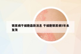 銀屑病干細(xì)胞最新消息 干細(xì)胞銀屑病5年未復(fù)發(fā)