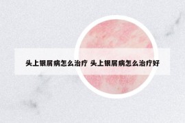 頭上銀屑病怎么治療 頭上銀屑病怎么治療好