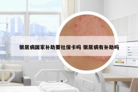 銀屑病國(guó)家補(bǔ)助要社?？▎?銀屑病有補(bǔ)助嗎