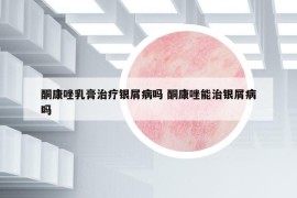 酮康唑乳膏治療銀屑病嗎 酮康唑能治銀屑病嗎