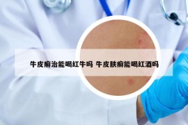 牛皮癬治能喝紅牛嗎 牛皮膚癬能喝紅酒嗎