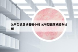 關節(jié)型銀屑病看哪個科 關節(jié)型銀屑病鑒別診斷