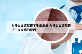 為什么會突然得了牛皮皮癬 為什么會突然得了牛皮皮癬的原因