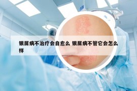 銀屑病不治療會(huì)自愈么 銀屑病不管它會(huì)怎么樣