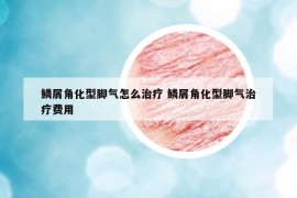 鱗屑角化型腳氣怎么治療 鱗屑角化型腳氣治療費用