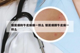 銀屑病和牛皮癬病一樣么 銀屑病跟牛皮癬一樣么