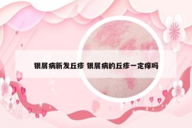 銀屑病新發(fā)丘疹 銀屑病的丘疹一定癢嗎