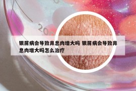 銀屑病會(huì)導(dǎo)致鼻息肉增大嗎 銀屑病會(huì)導(dǎo)致鼻息肉增大嗎怎么治療