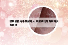 銀屑病能吃牛黃解毒片 銀屑病吃牛黃解毒片有用嗎
