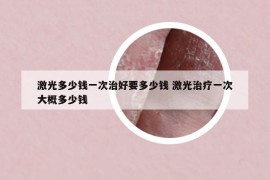激光多少錢一次治好要多少錢 激光治療一次大概多少錢