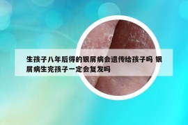 生孩子八年后得的銀屑病會(huì)遺傳給孩子嗎 銀屑病生完孩子一定會(huì)復(fù)發(fā)嗎