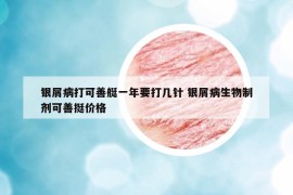 銀屑病打可善艇一年要打幾針 銀屑病生物制劑可善挺價(jià)格