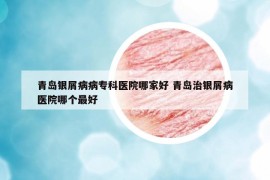 青島銀屑病病專科醫(yī)院哪家好 青島治銀屑病醫(yī)院哪個最好