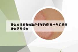 什么方法能有效治療多年的癬 幾十年的癬擦什么藥可根治
