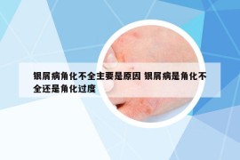 銀屑病角化不全主要是原因 銀屑病是角化不全還是角化過度