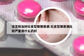 該怎樣治好紅皮型銀銀屑病 紅皮型銀屑病比較嚴(yán)重用什么藥好