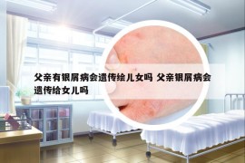 父親有銀屑病會遺傳繪兒女嗎 父親銀屑病會遺傳給女兒嗎
